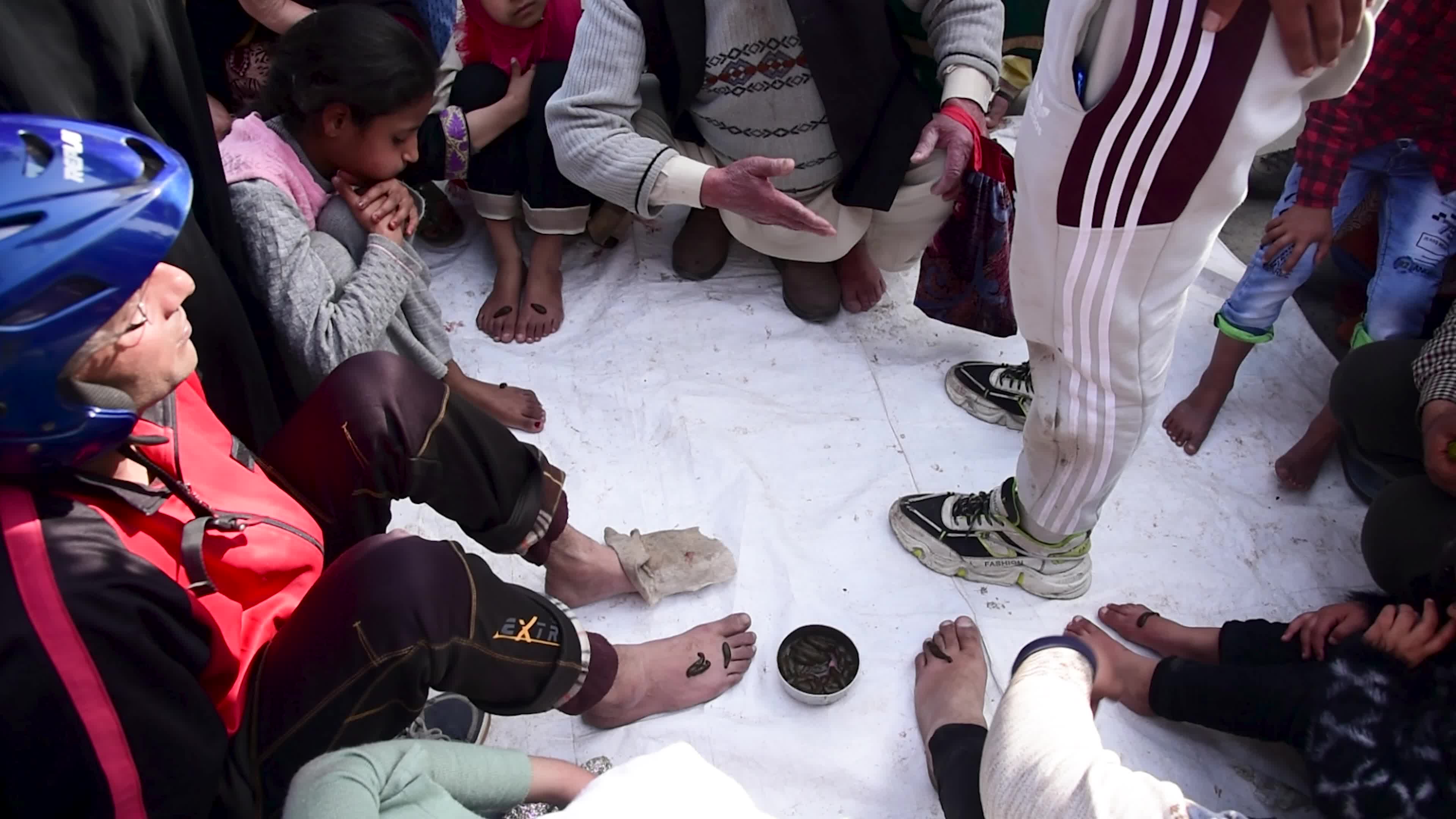 Bloodletting with Leeches in Indian administered Kashmir