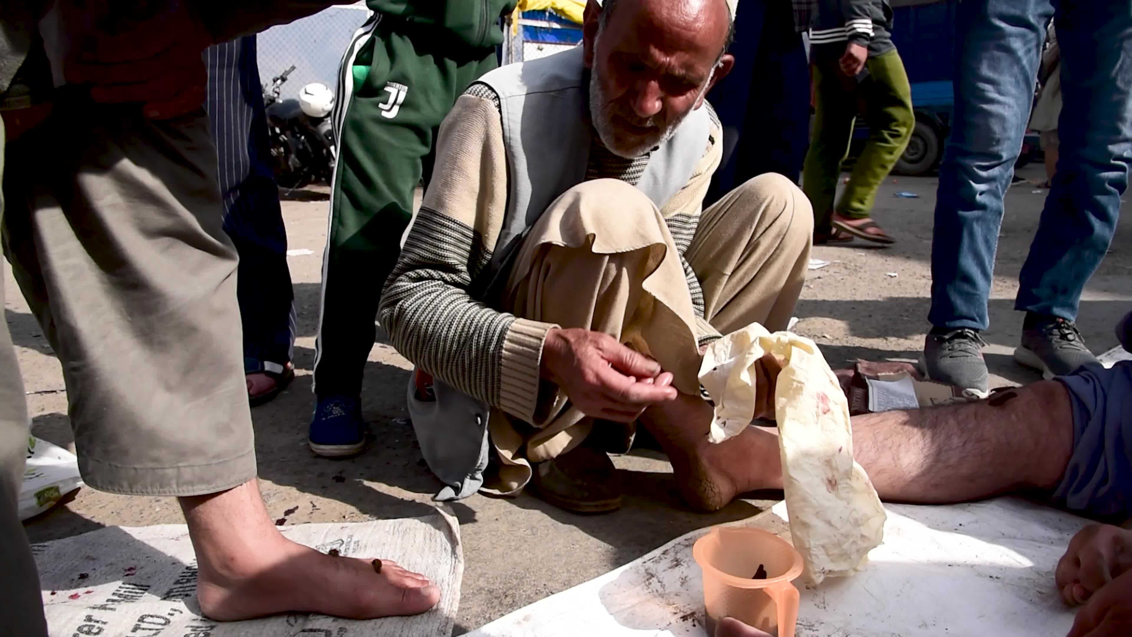 Bloodletting with Leeches in Indian administered Kashmir