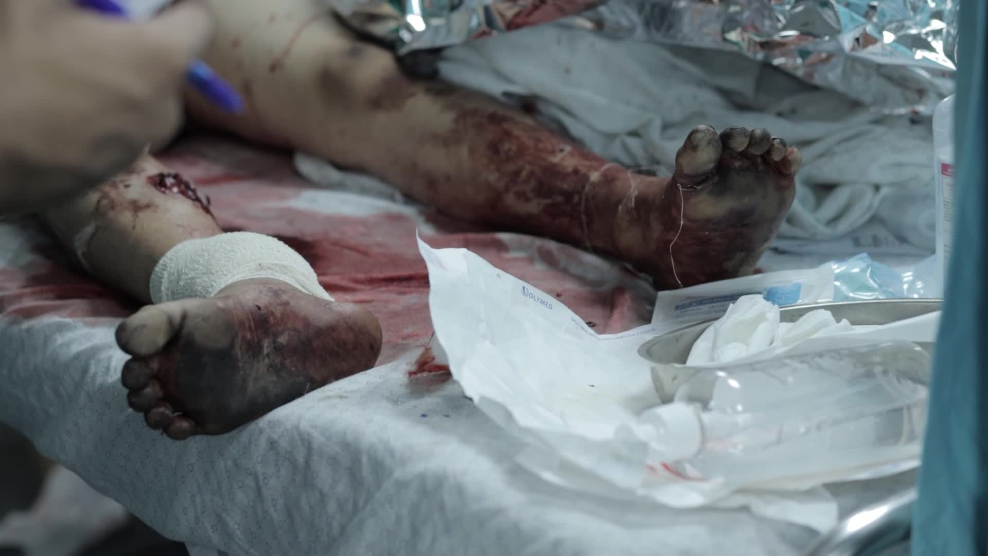 Wounded Palestinians At Shifa Hospital Following Israeli Air Strike