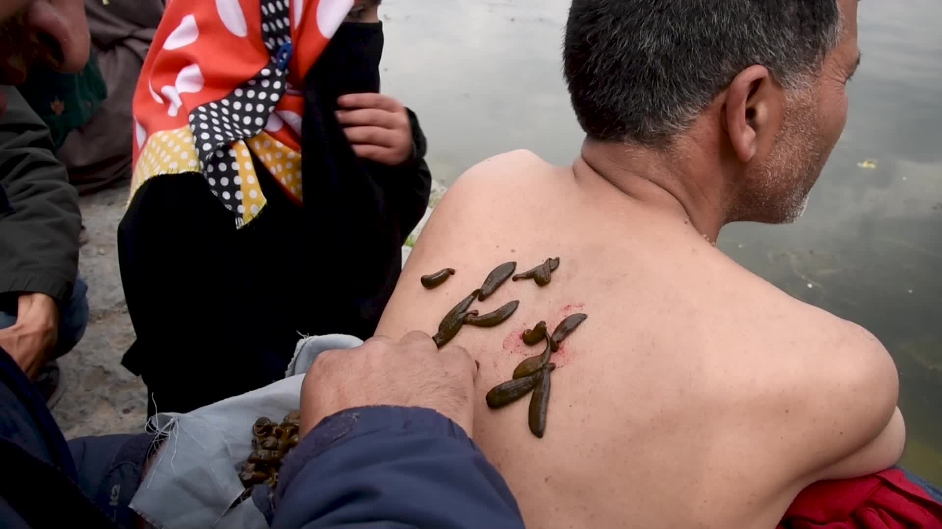 Bloodletting with Leeches in Kashmir