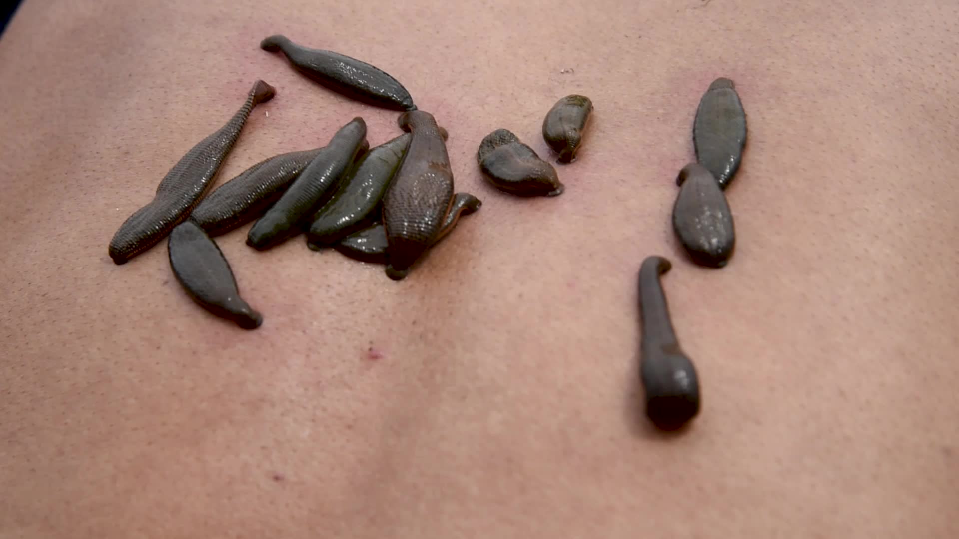 Bloodletting with Leeches in Kashmir