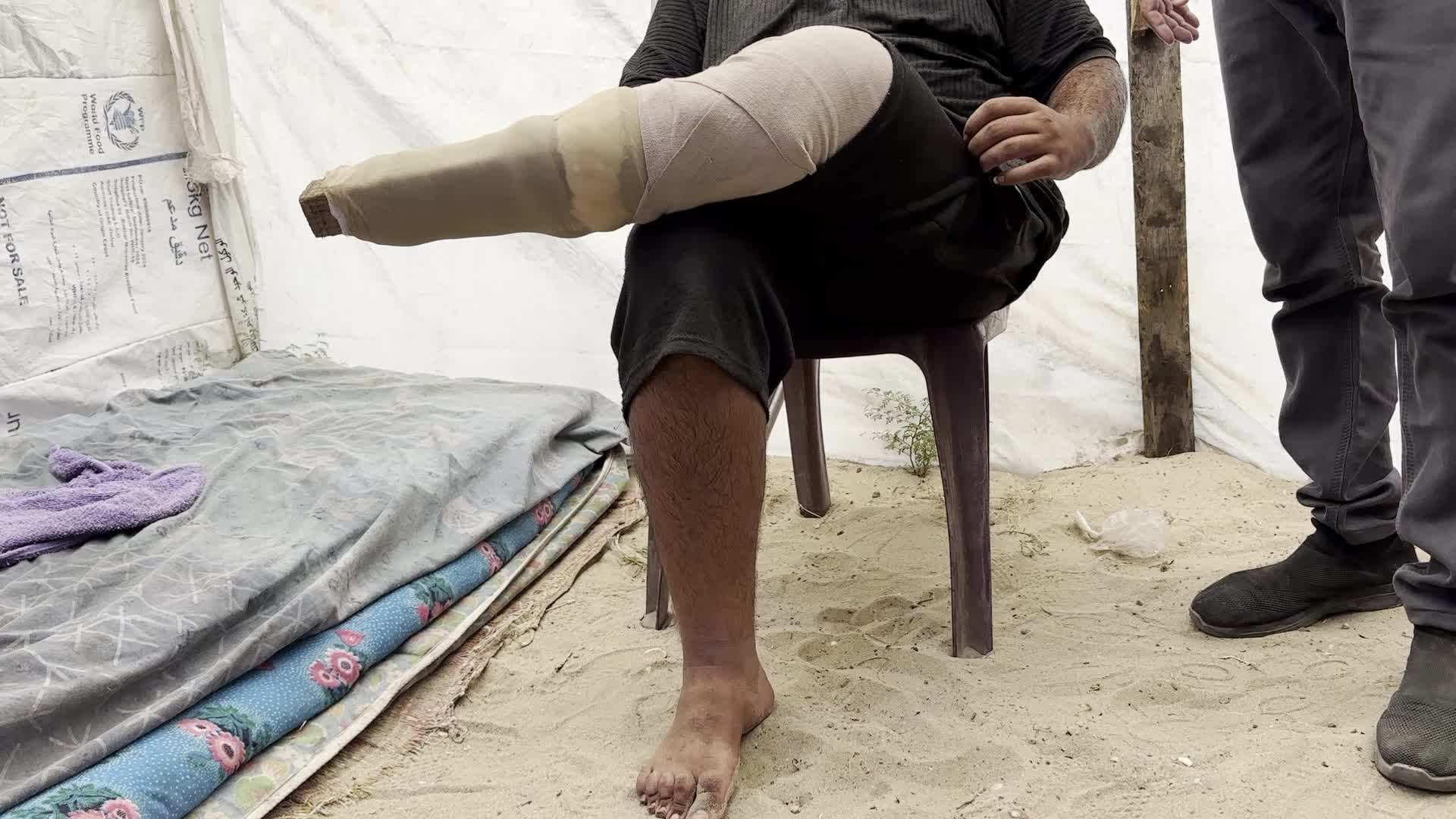 Displaced Palestinian Receives Prosthetic Limb Amid Hamas-Israel Conflict