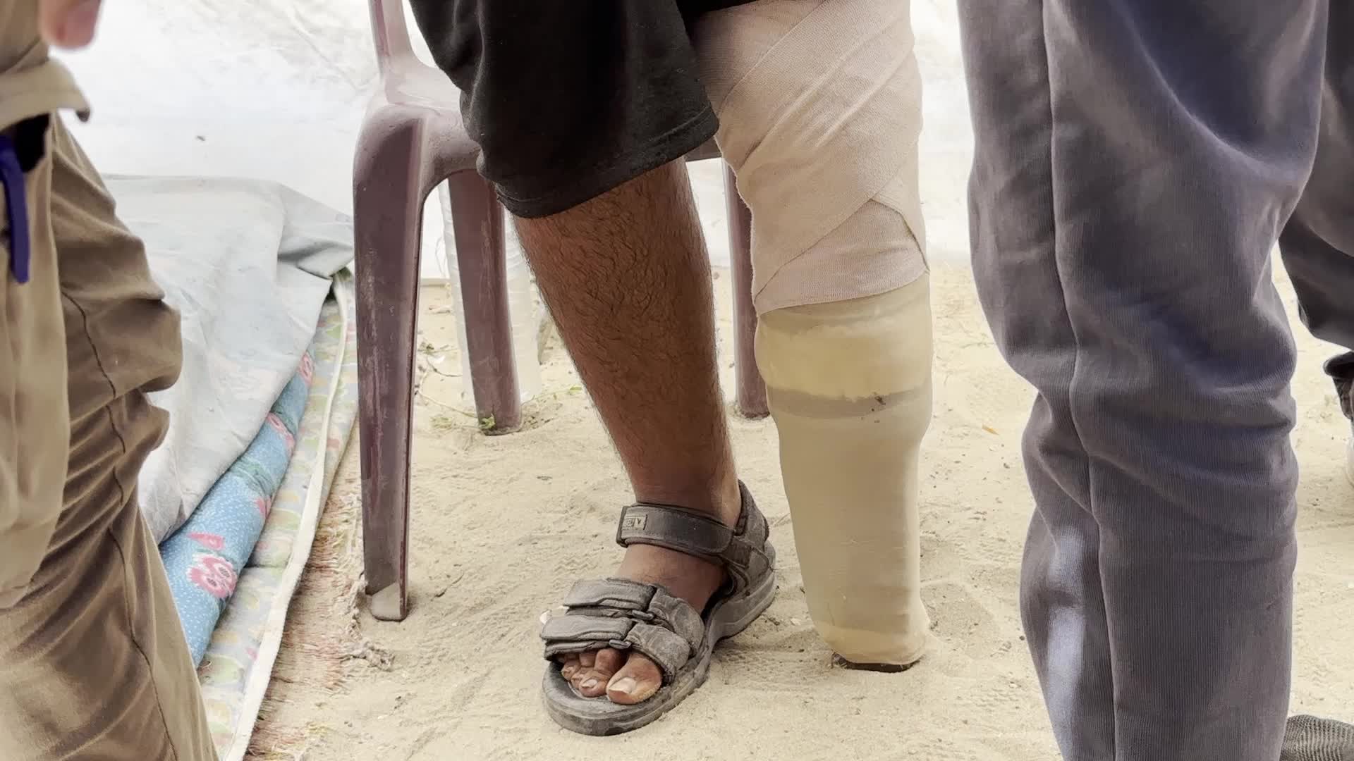 Displaced Palestinian Receives Prosthetic Limb Amid Hamas-Israel Conflict