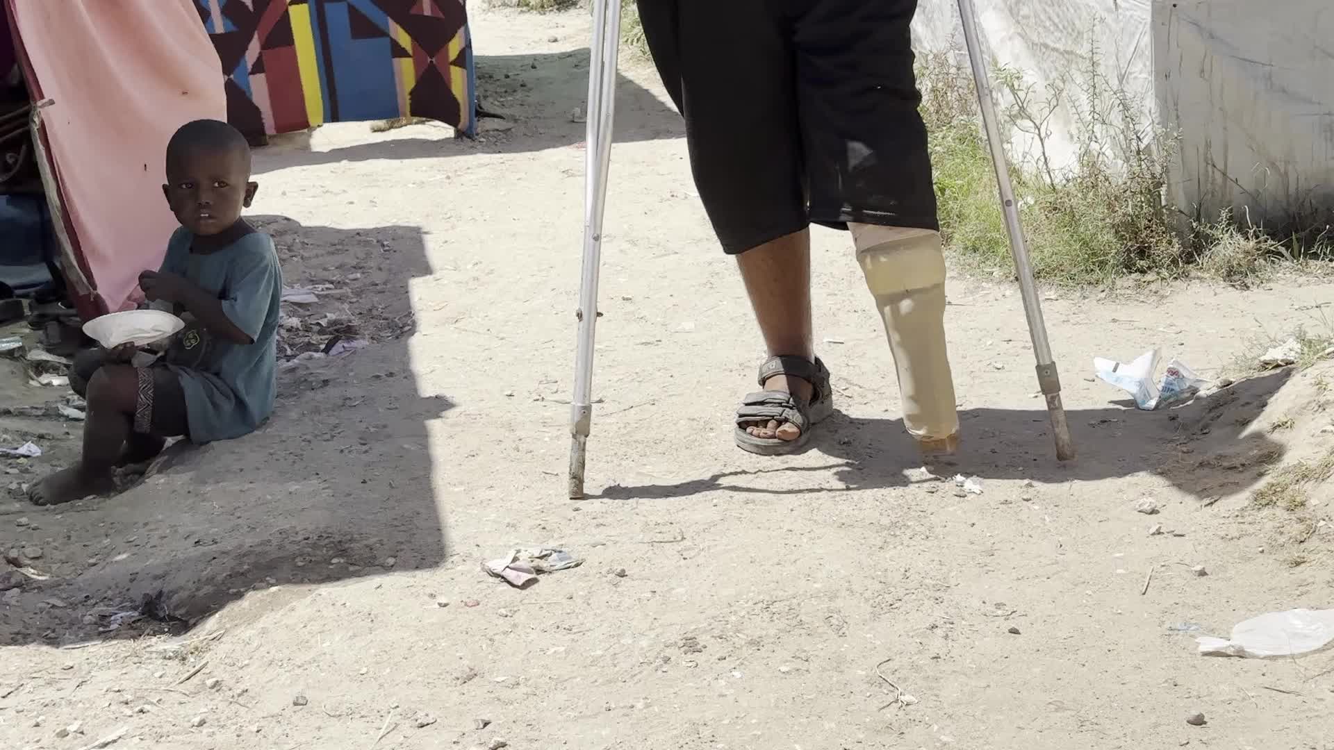 Displaced Palestinian Receives Prosthetic Limb Amid Hamas-Israel Conflict
