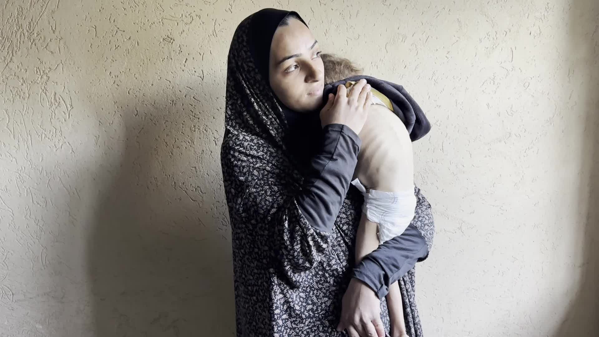 Malnutrition In Gaza Amid Hamas-Israel Conflict