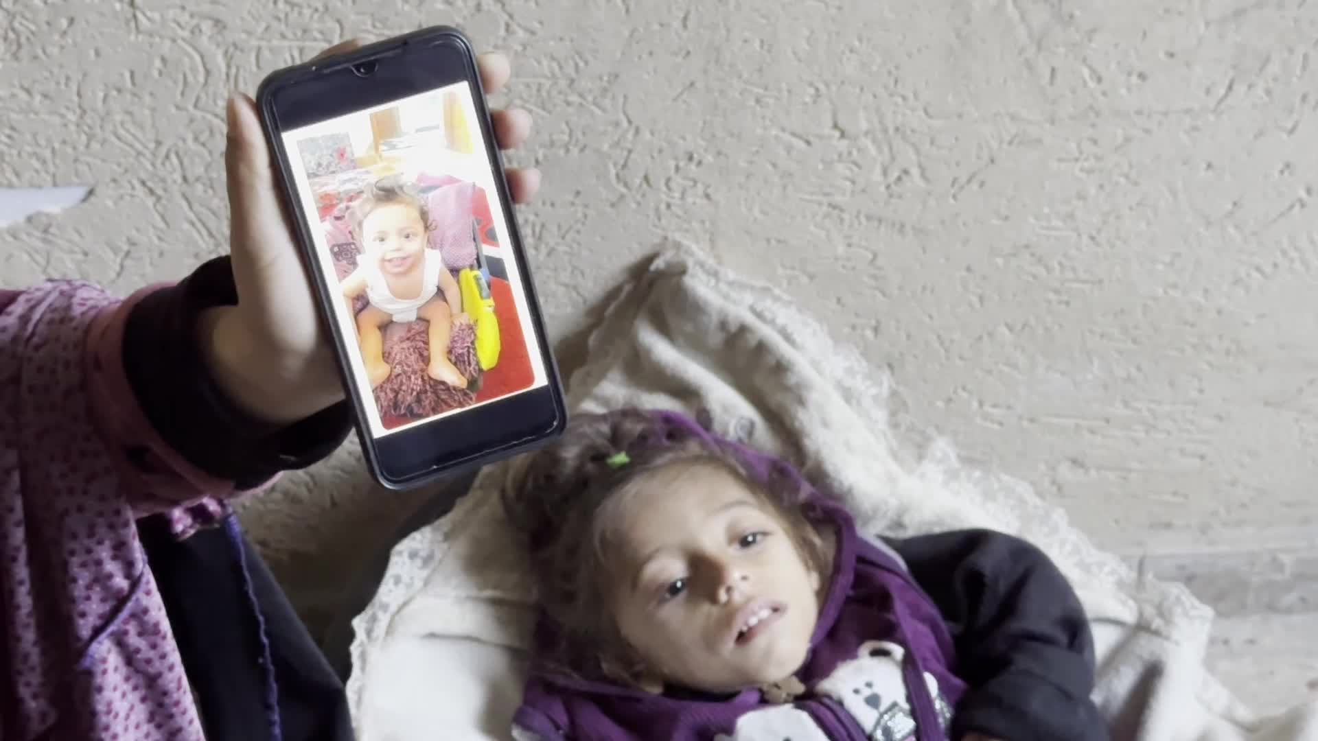 Malnutrition In Gaza Amid Hamas-Israel Conflict