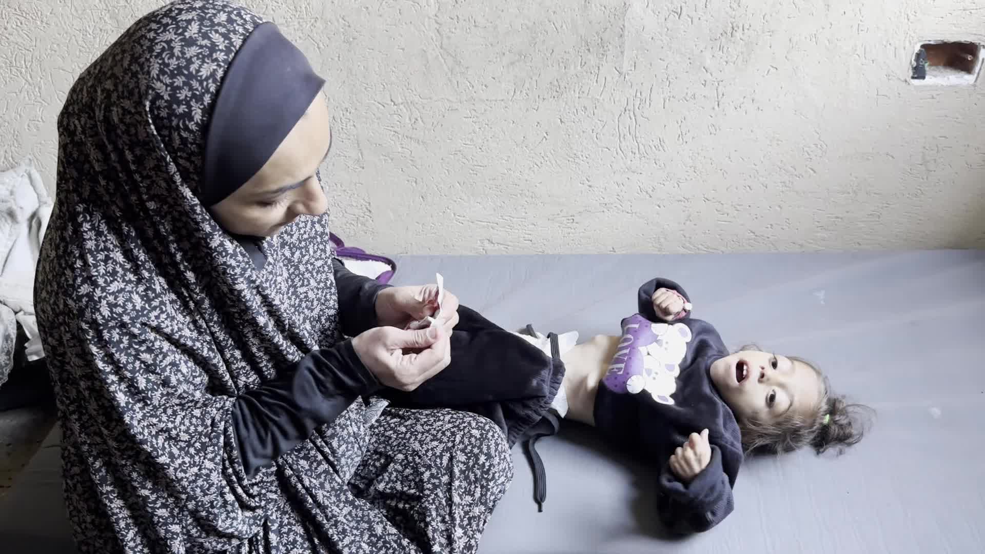 Malnutrition In Gaza Amid Hamas-Israel Conflict