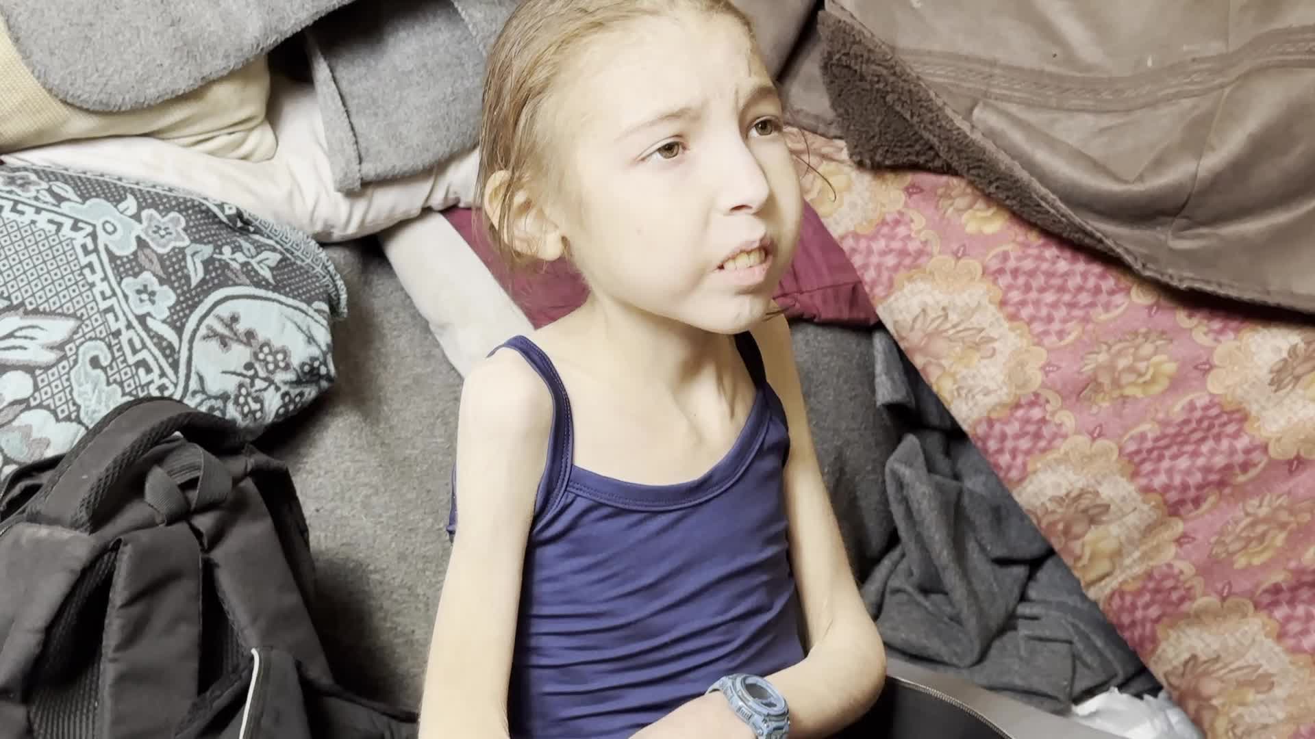 Malnutrition Crisis In Gaza Amid Hamas-Israel Confilct