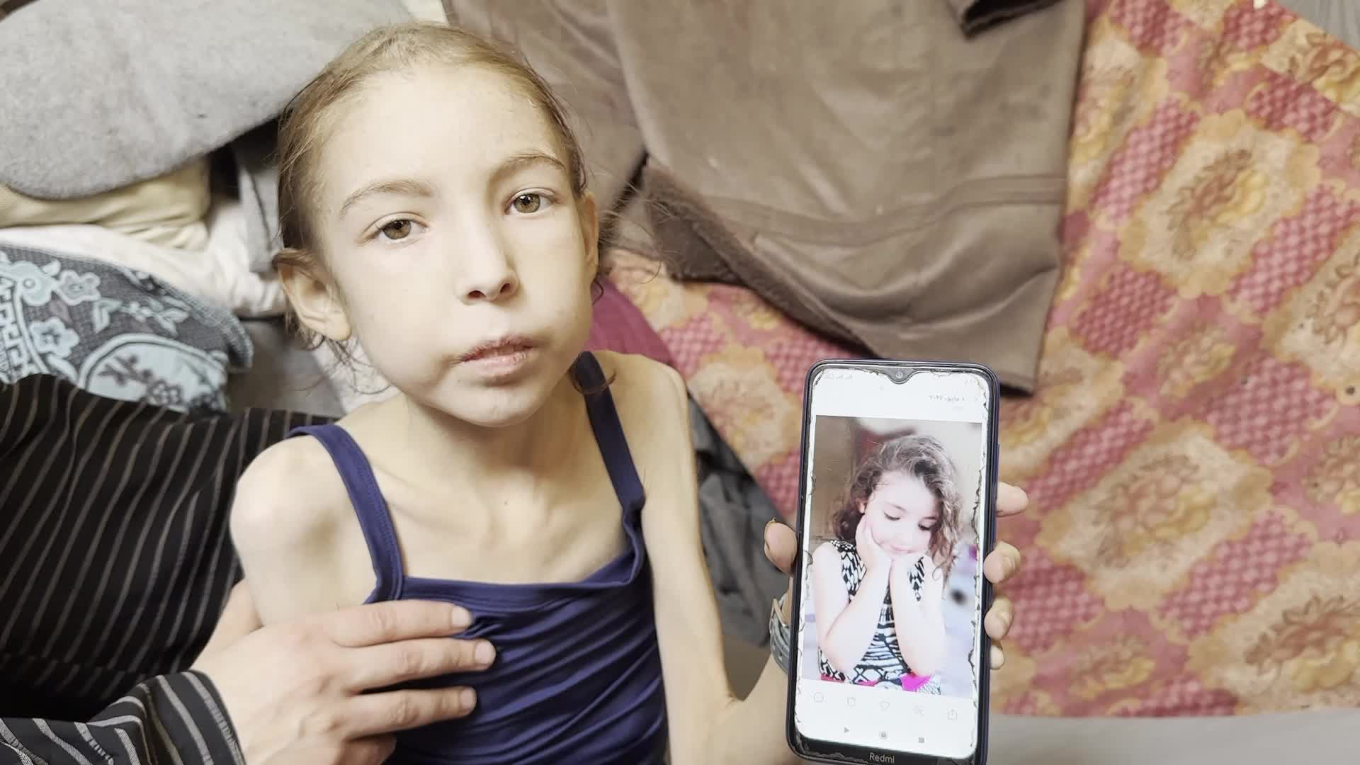 Malnutrition Crisis In Gaza Amid Hamas-Israel Confilct
