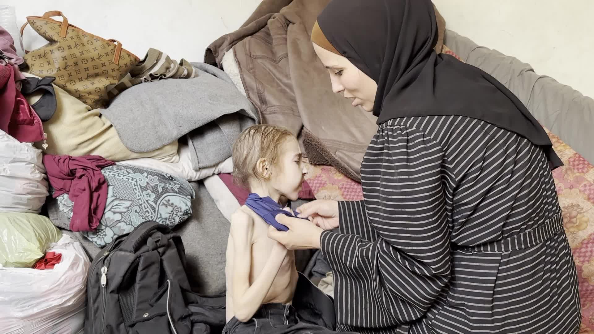 Malnutrition Crisis In Gaza Amid Hamas-Israel Confilct