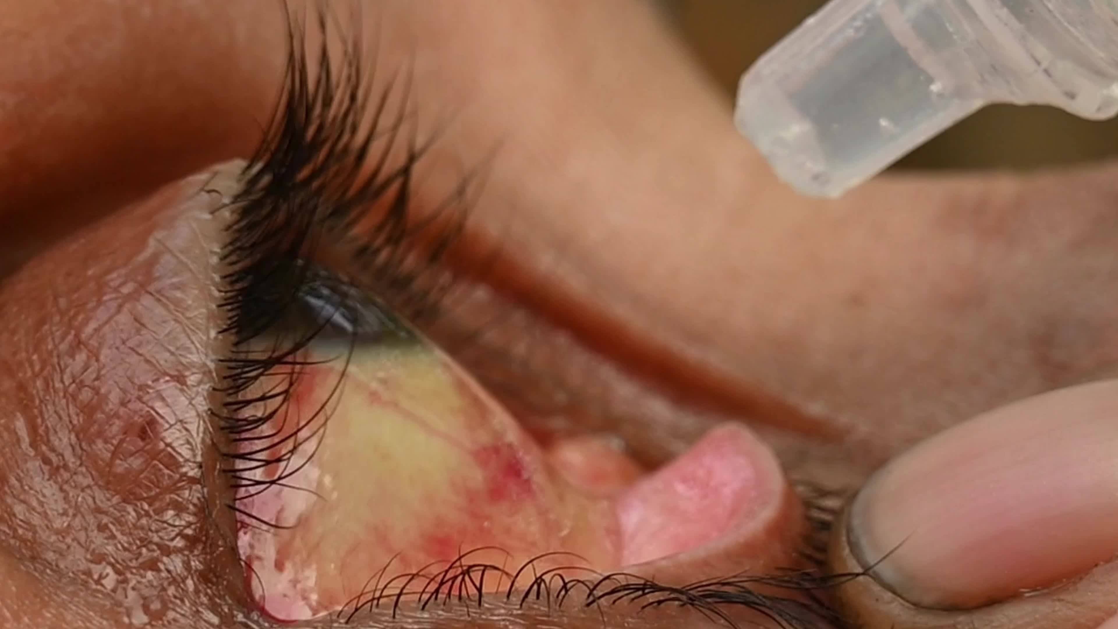 Allergic Conjunctivitis - Health
