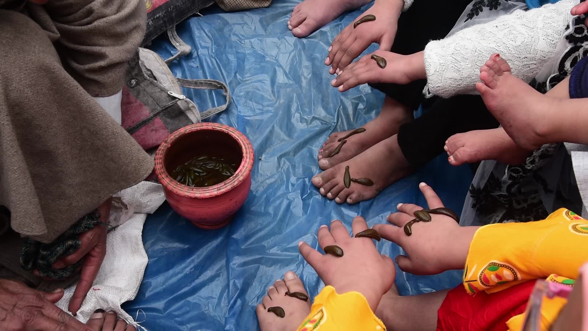 Leech treatment in Srinagar