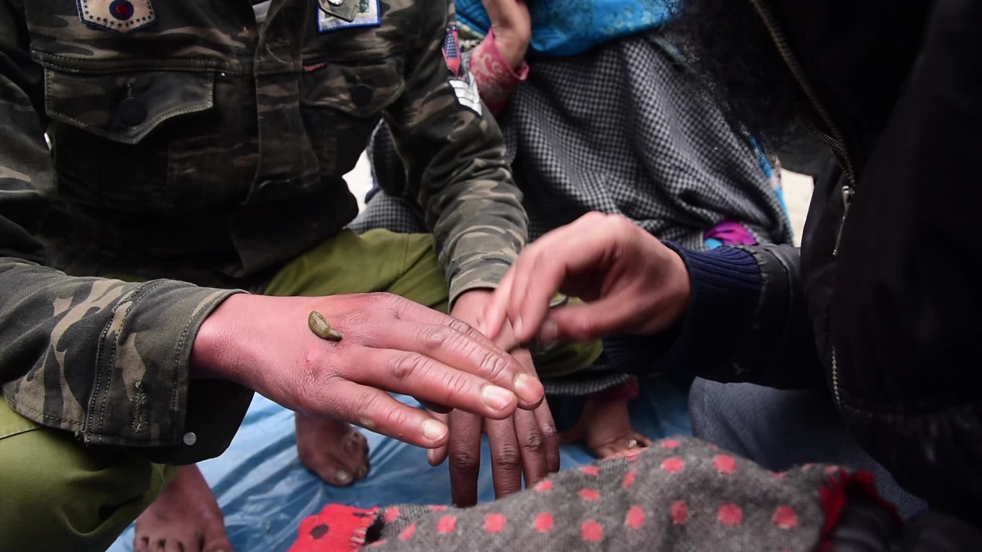 Leech treatment in Srinagar