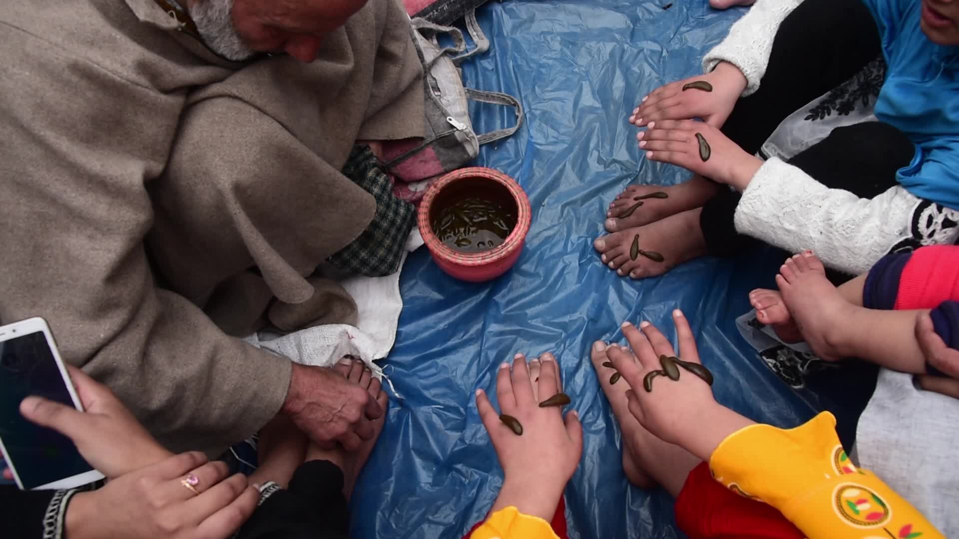 Leech treatment in Srinagar