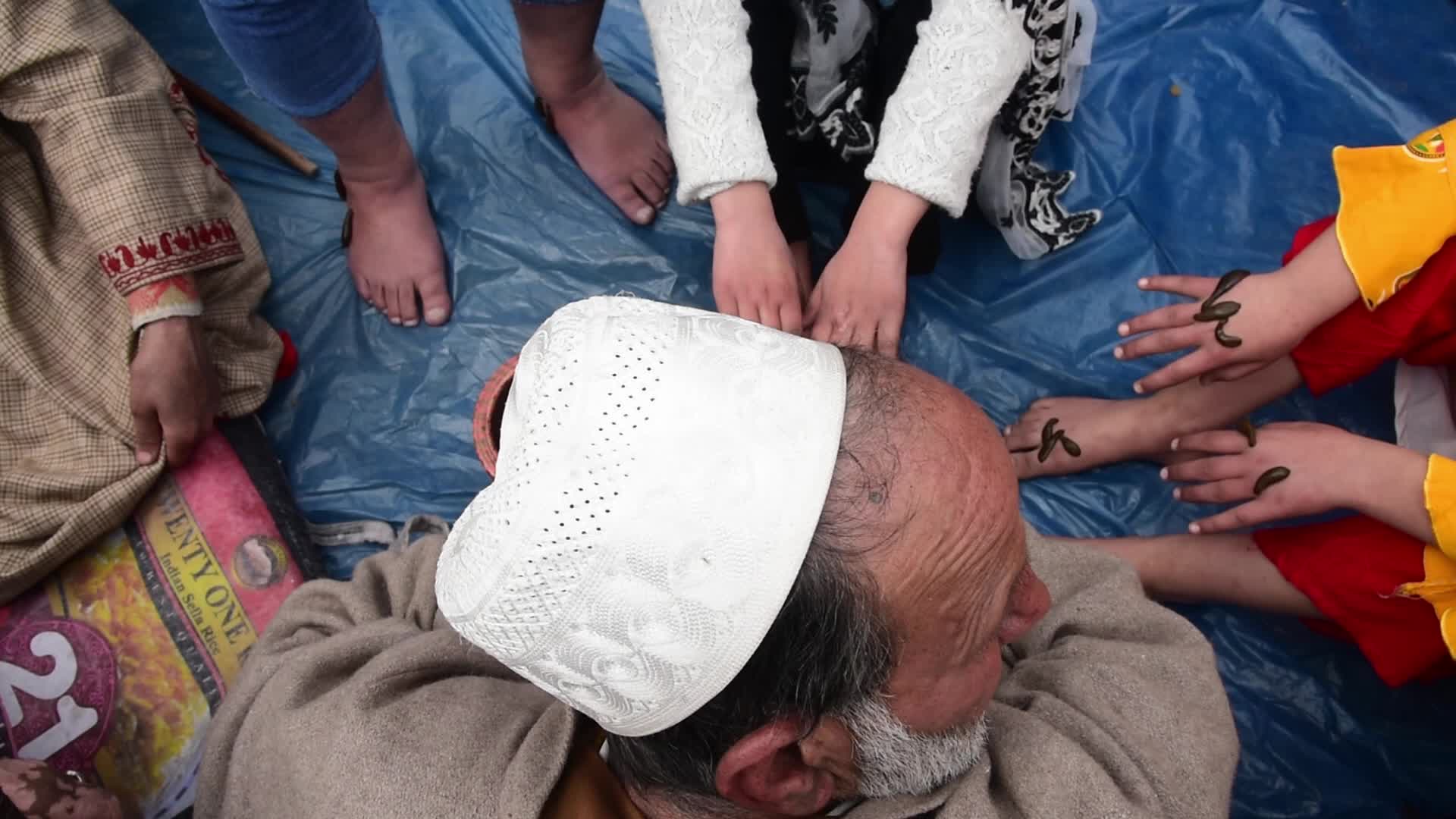 Leech treatment in Srinagar