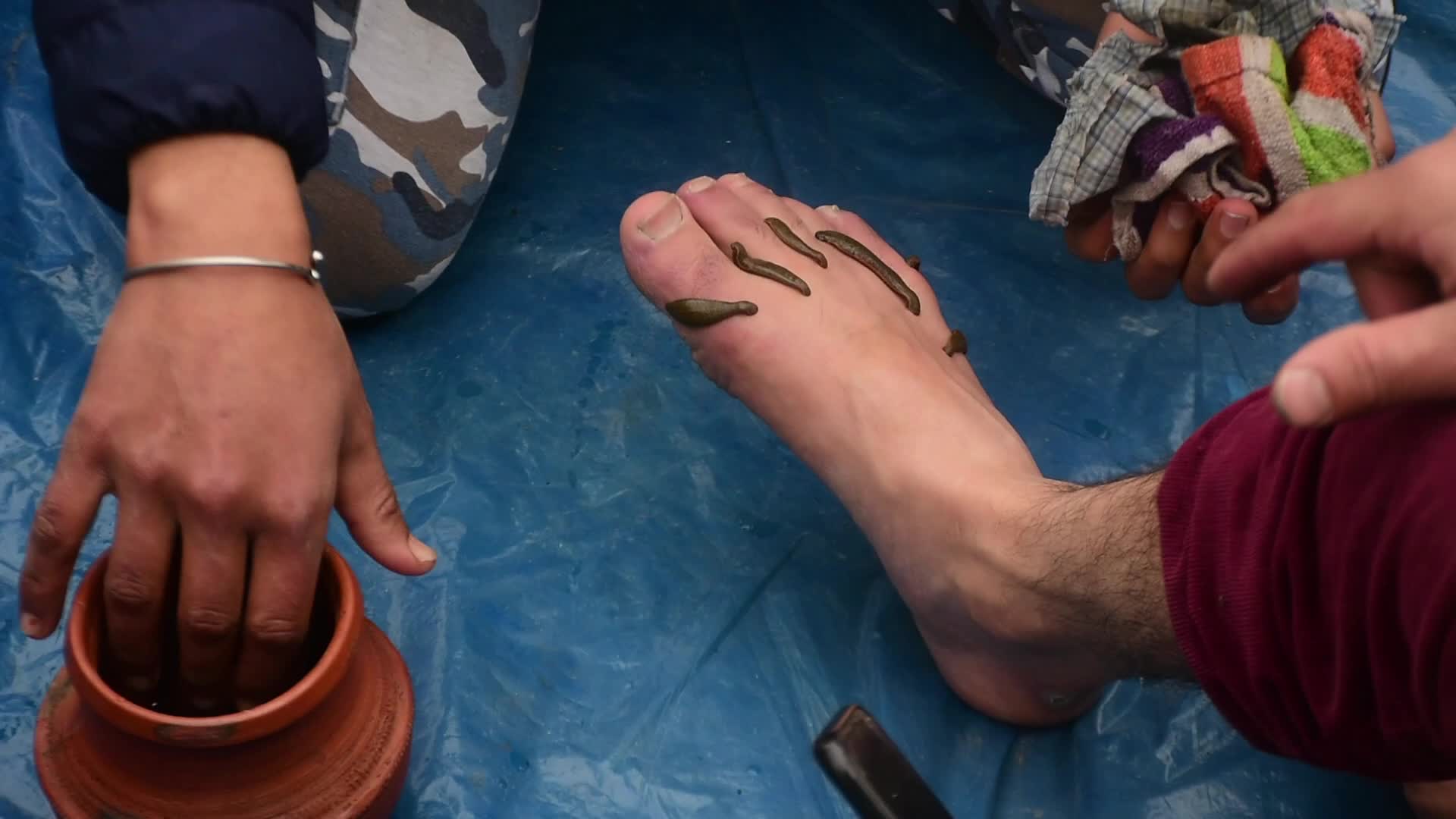 Leech Therapy in Kashmir