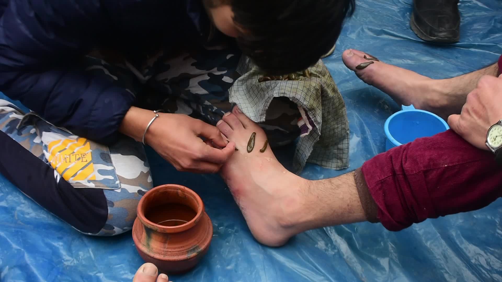 Leech Therapy in Kashmir