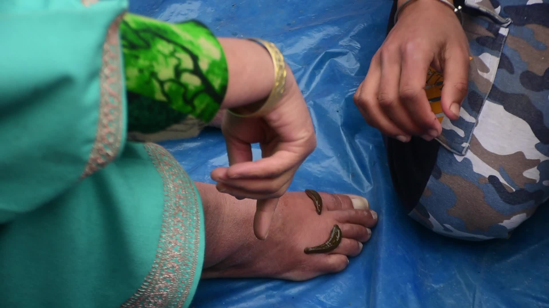 Leech Therapy in Kashmir