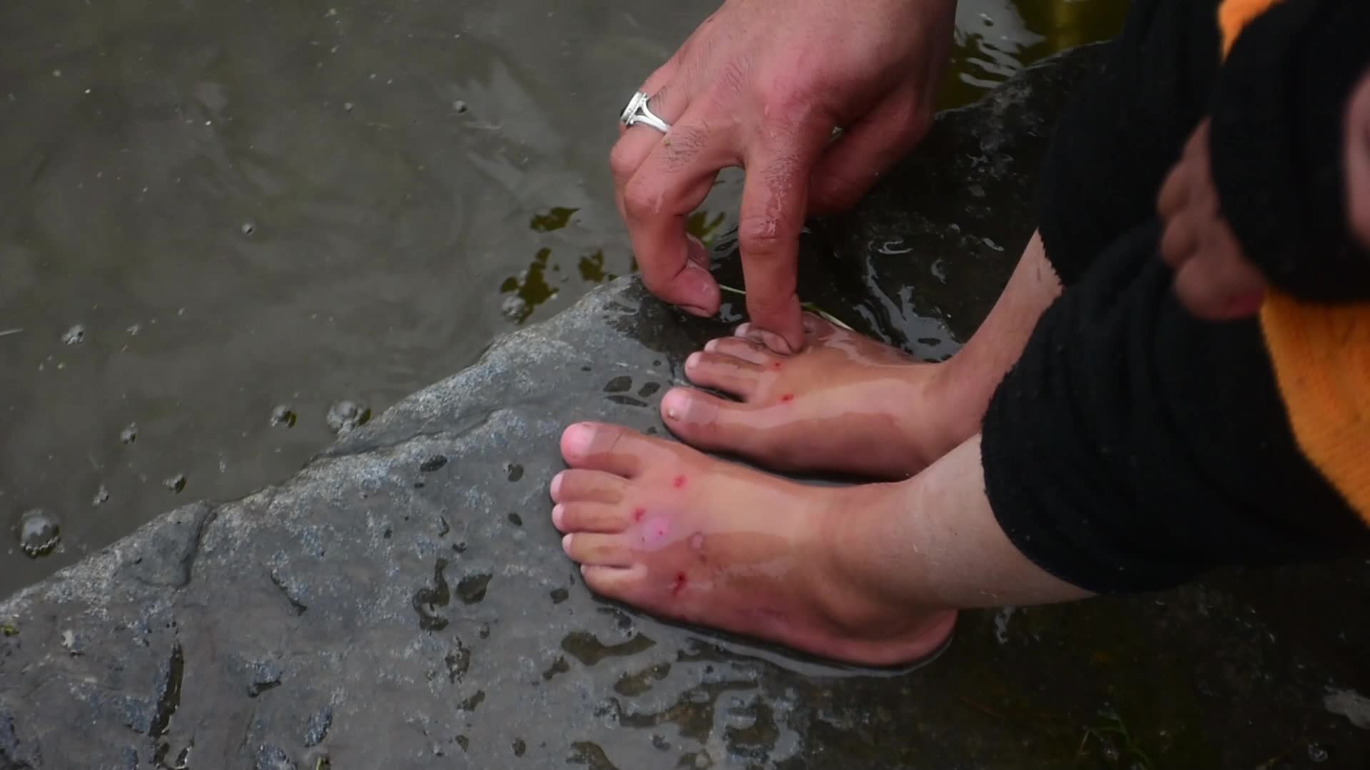 Leech Therapy in Kashmir