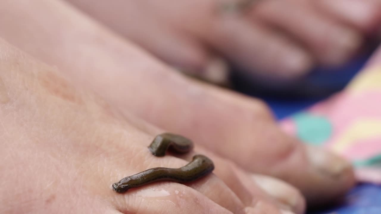 Leech Therapy Marks Nowruz In Kashmir