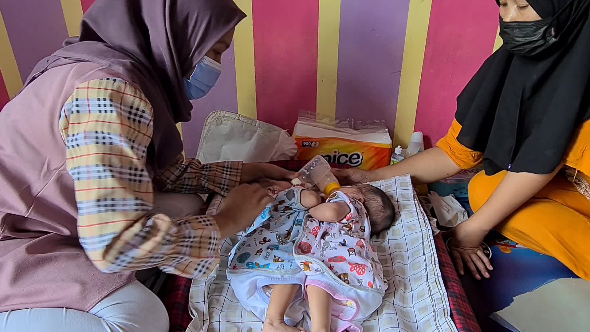 Conjoined twins Awaiting Funds for Separation Operation in Indonesia 
