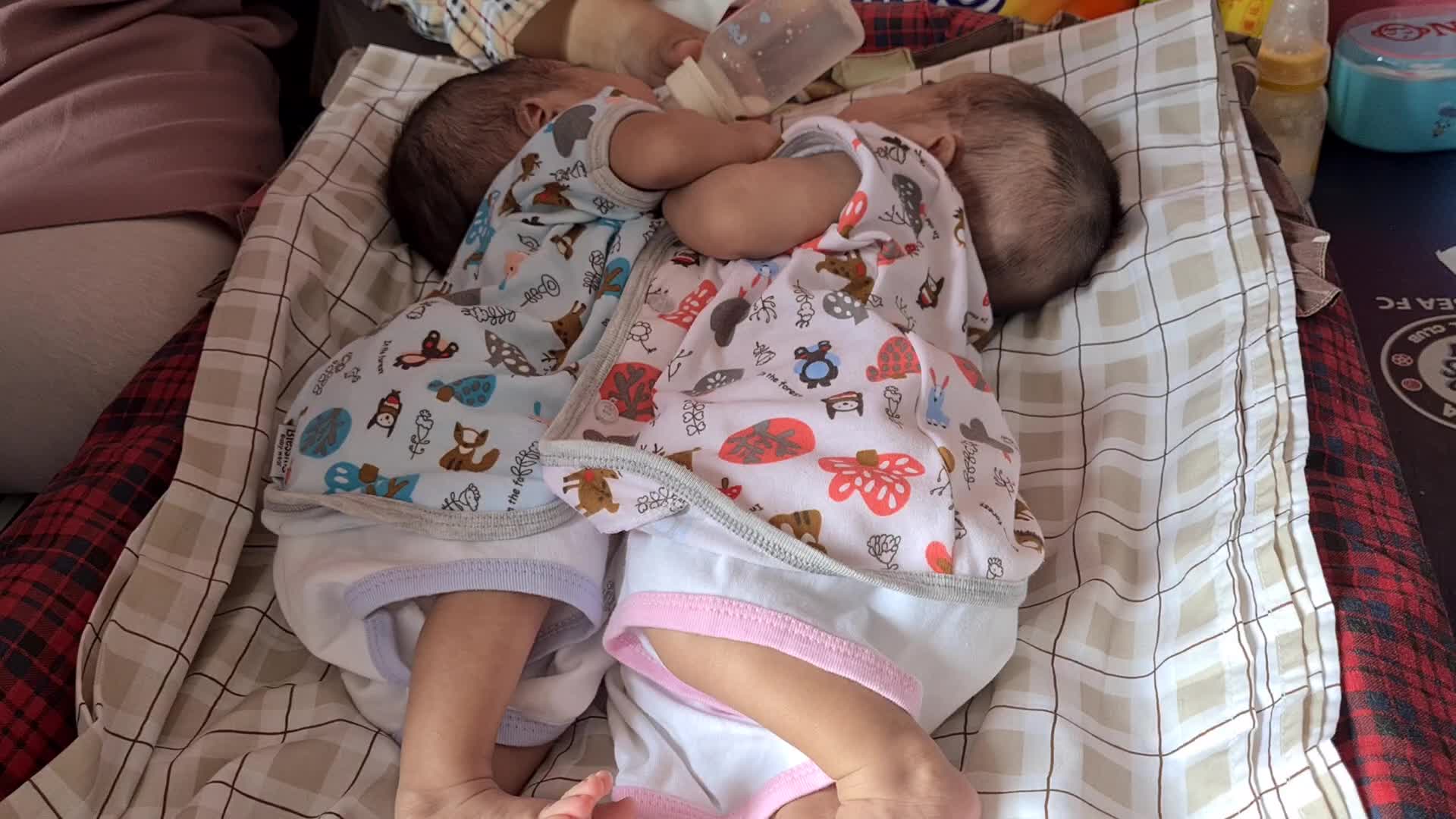 Conjoined twins Awaiting Funds for Separation Operation in Indonesia 