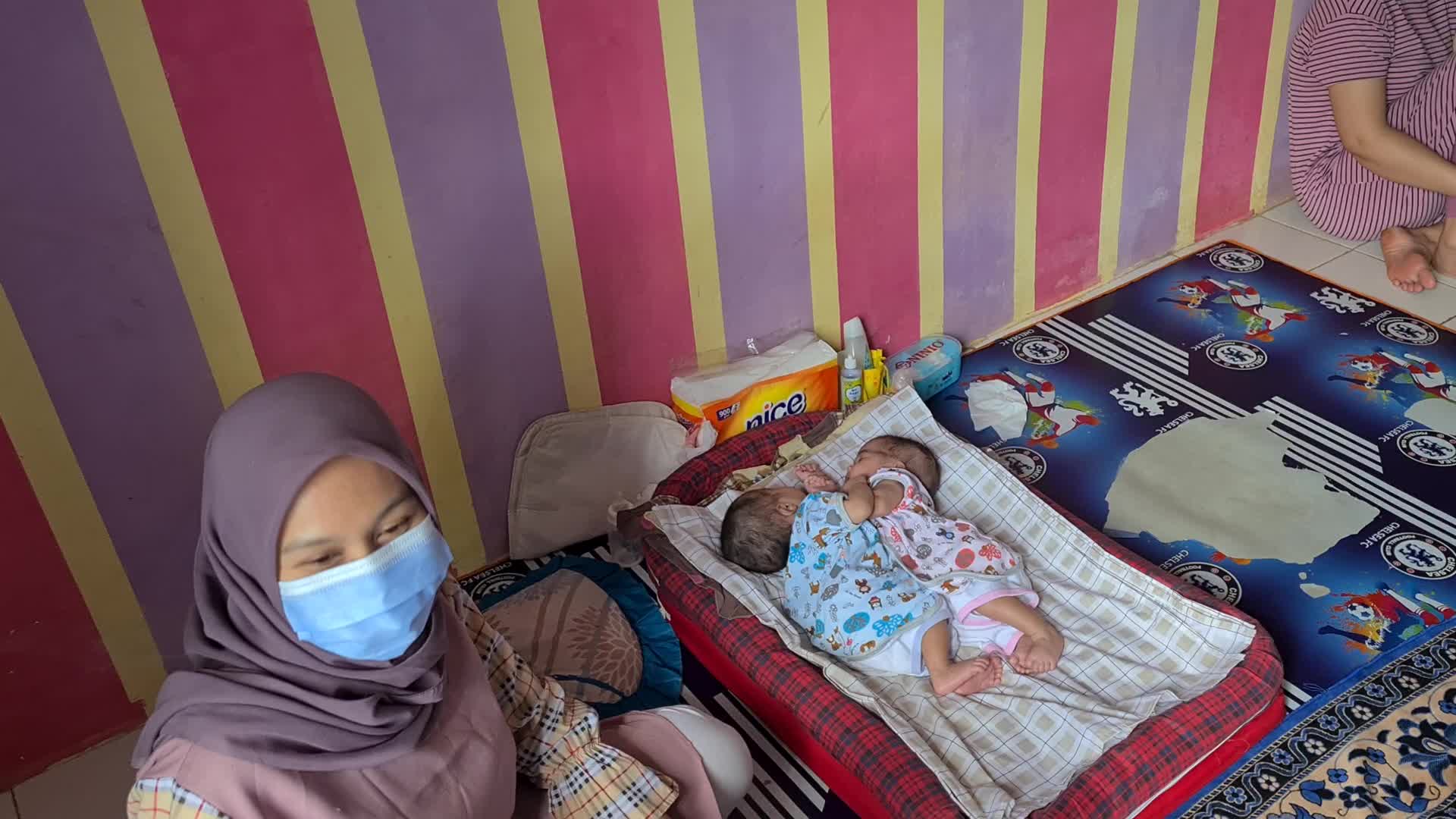 Conjoined twins Awaiting Funds for Separation Operation in Indonesia 